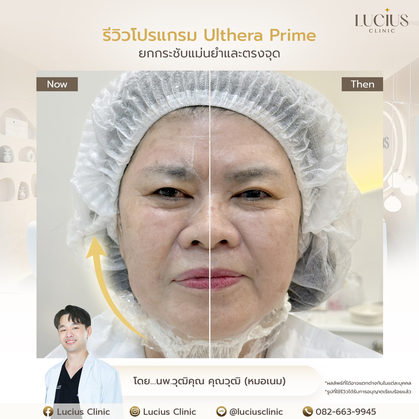 รีวิว Ulthera Prime