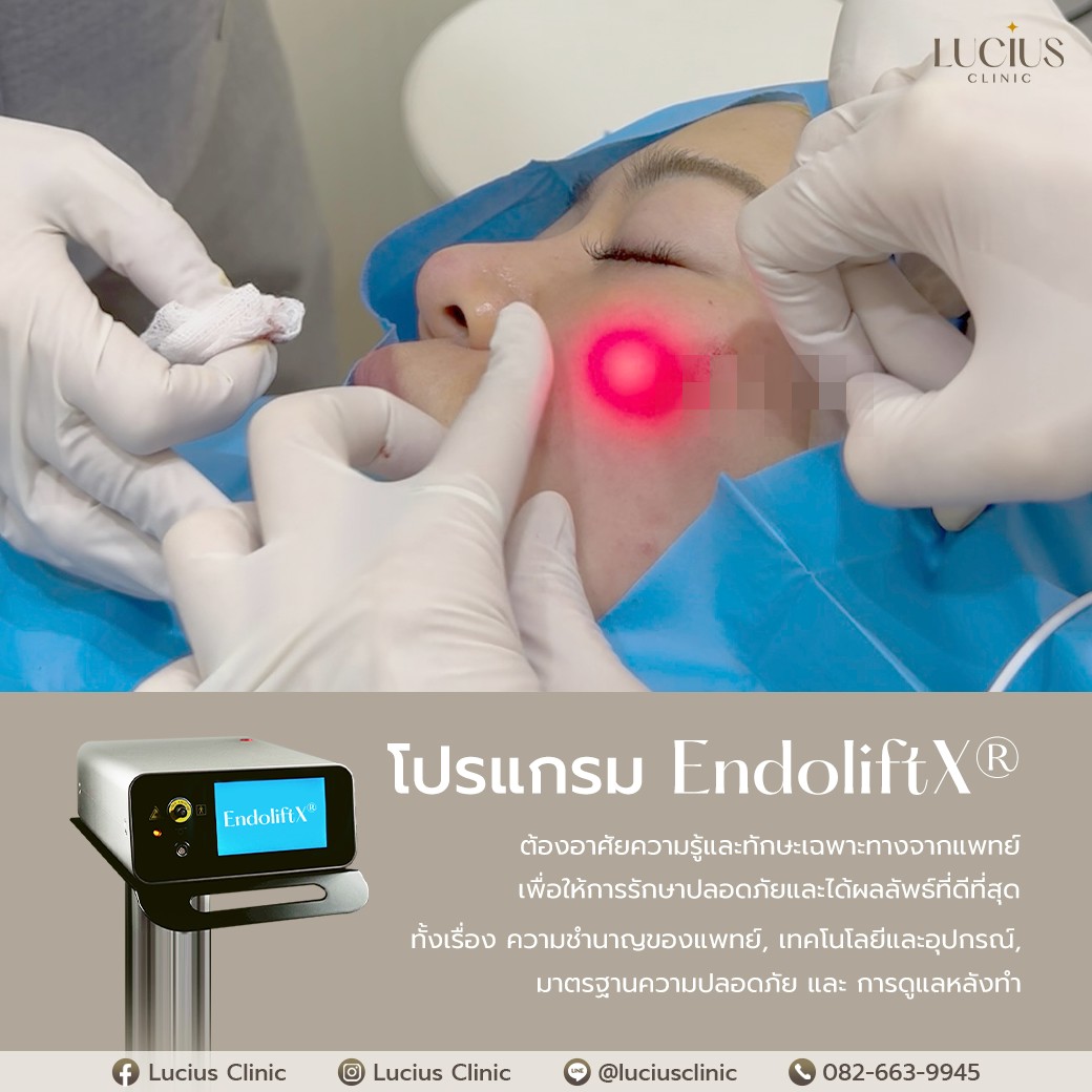 Endolift X Expertise