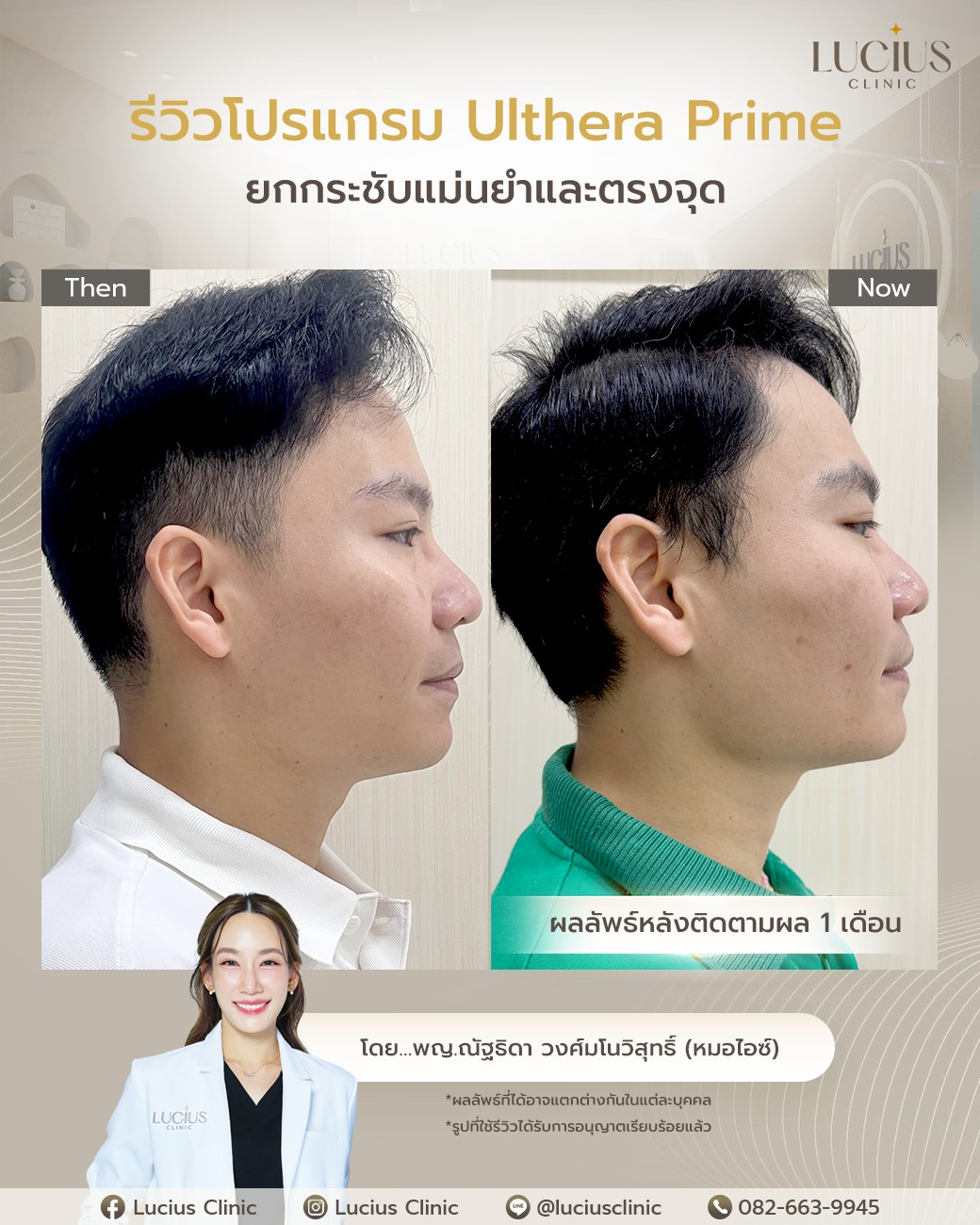 รีวิว Ulthera Prime